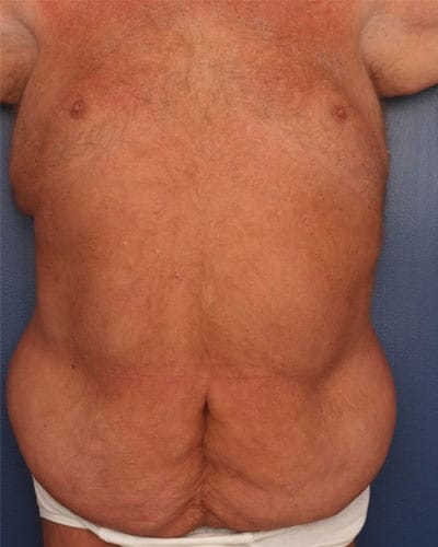 Before Image: After Large Weight Loss - front