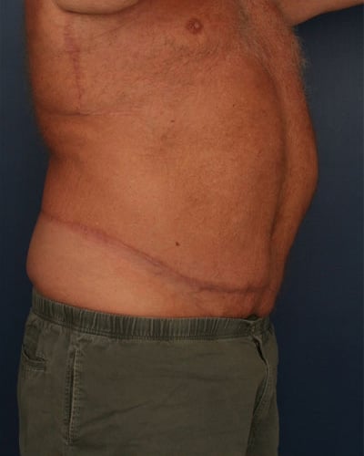 After Image: After Large Weight Loss - right-front-oblique