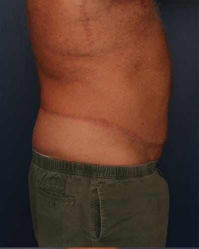 After Image: After Large Weight Loss - right-side