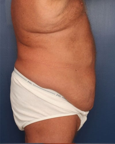 Before Image: After Large Weight Loss - right-side