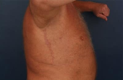 After Image: After Large Weight Loss - right-side