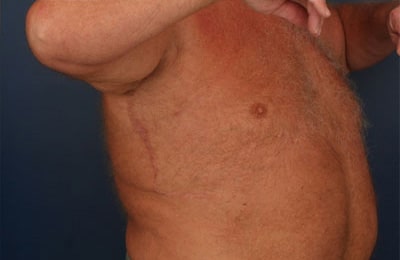 After Image: After Large Weight Loss - right-front-oblique