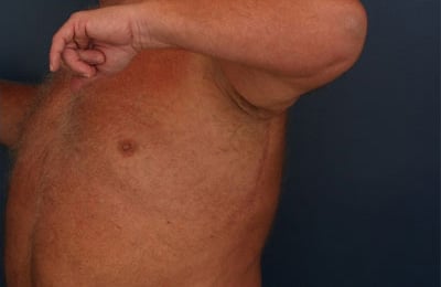 After Image: After Large Weight Loss -