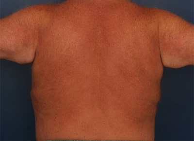 After Image: After Large Weight Loss - front