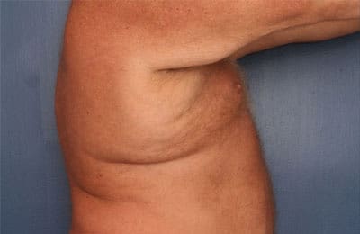 Before Image: After Large Weight Loss - right-side