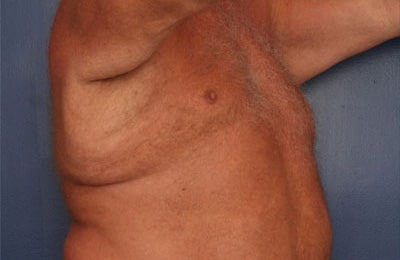 Before Image: After Large Weight Loss - right-front-oblique