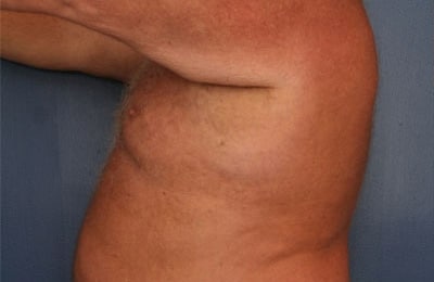 Before Image: After Large Weight Loss - front