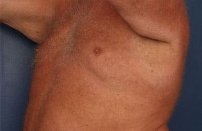 Before Image: After Large Weight Loss -