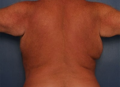 Before Image: After Large Weight Loss - front
