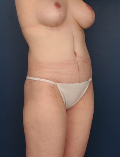 After Image: After Large Weight Loss - right-front-oblique