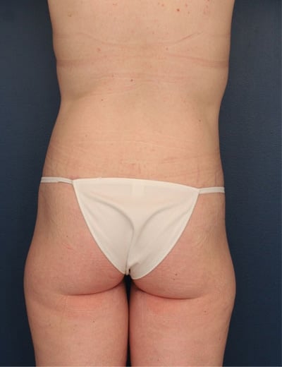 After Image: After Large Weight Loss - back