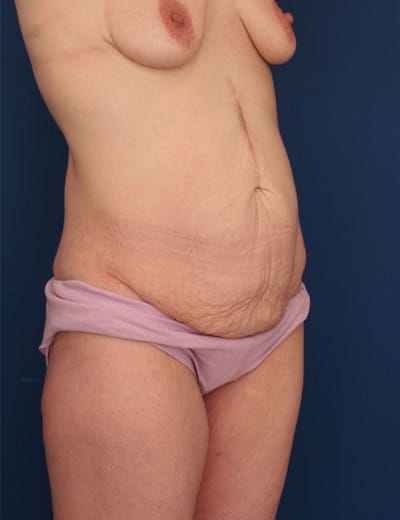 Before Image: After Large Weight Loss - right-front-oblique