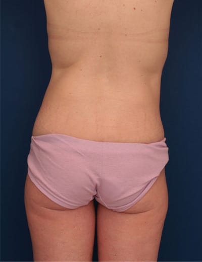 Before Image: After Large Weight Loss - back