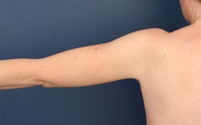 After Image: After Large Weight Loss - back