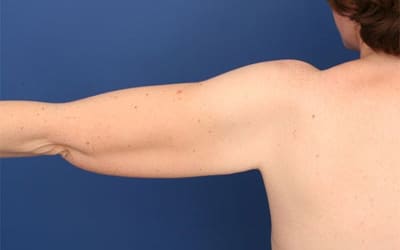 Before Image: After Large Weight Loss - back