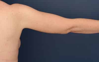 After Image: After Large Weight Loss - back