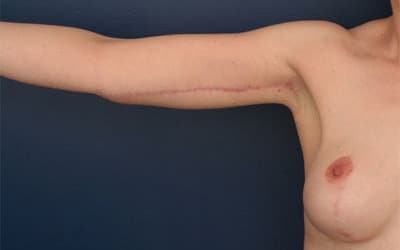 After Image: After Large Weight Loss -