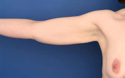 Before Image: After Large Weight Loss -