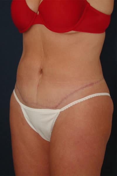 After Image: After Large Weight Loss - left-front-oblique