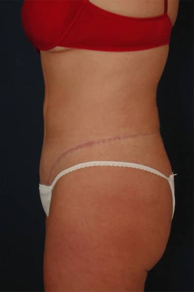 After Image: After Large Weight Loss - left-side