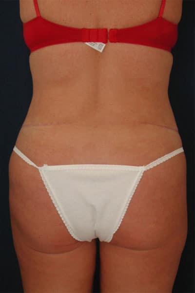 After Image: After Large Weight Loss - back