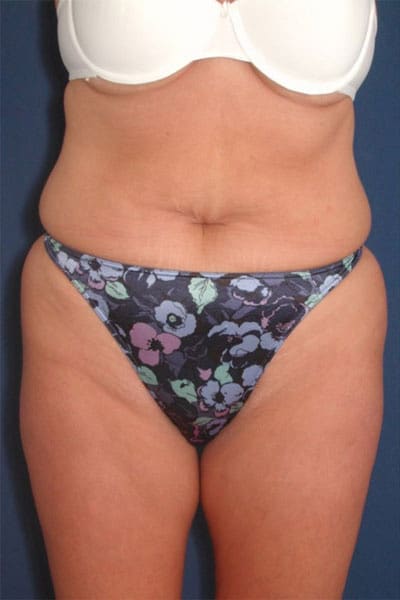 Before Image: After Large Weight Loss - front