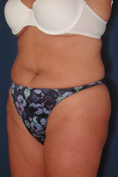 Before Image: After Large Weight Loss - left-front-oblique