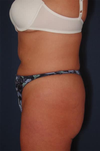 Before Image: After Large Weight Loss - left-side
