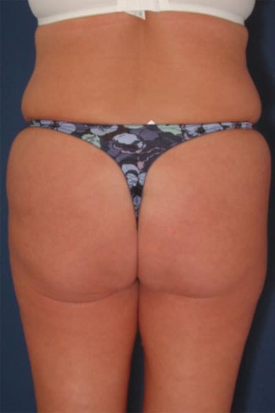 Before Image: After Large Weight Loss - back