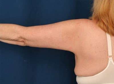 After Image: After Large Weight Loss - back