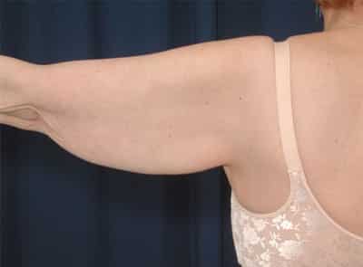 Before Image: After Large Weight Loss - back