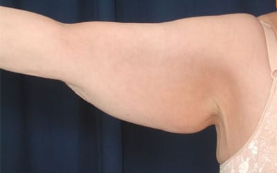 Before Image: After Large Weight Loss - back