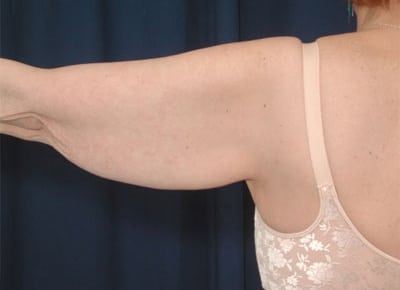 Before Image: After Large Weight Loss - back