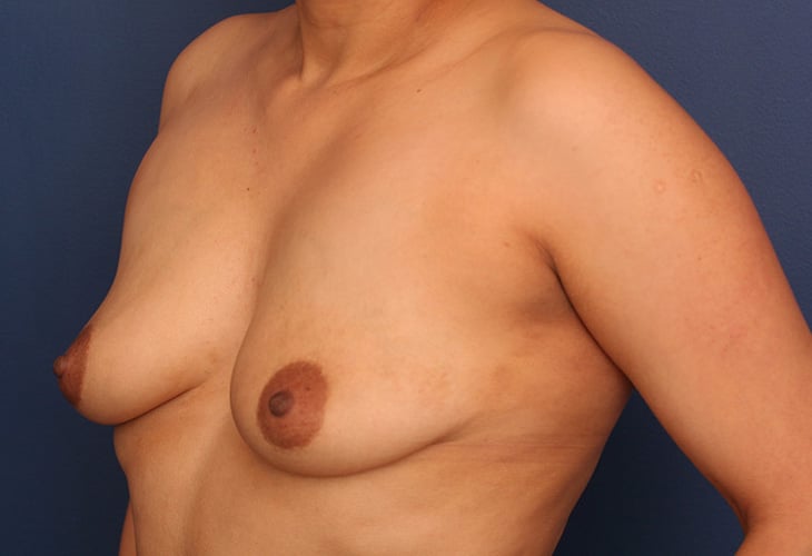 Before Image: Breast Augmentation - left-front-oblique