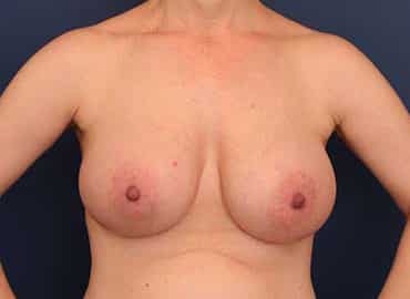 After Image: Breast Augmentation - front
