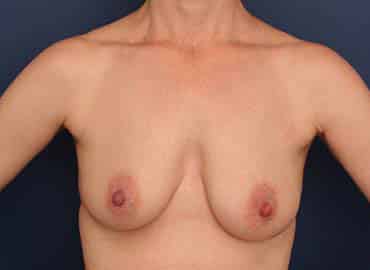 Before Image: Breast Augmentation - front