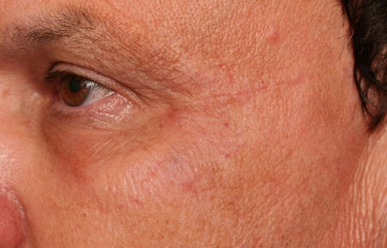 After Image: Crows Feet Volbella - left-front-oblique