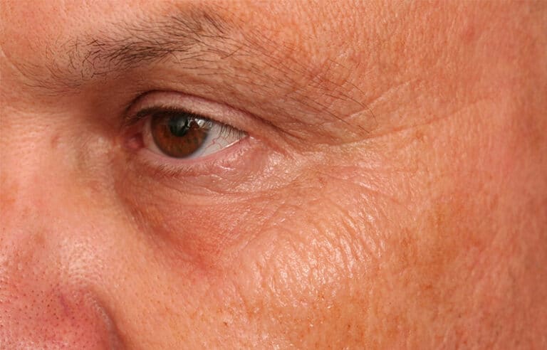 Before Image: Crows Feet Volbella - left-front-oblique