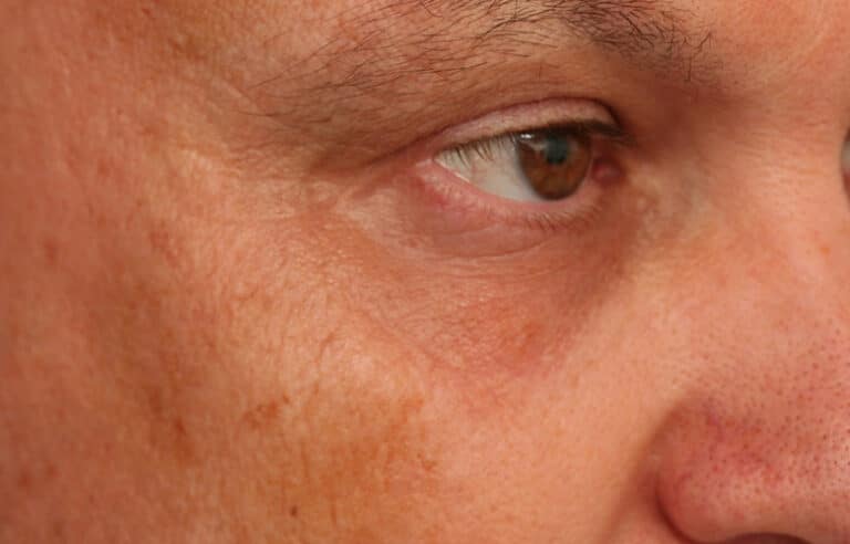 Before Image: Crows Feet Volbella - right-front-oblique