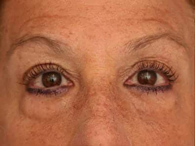 Before Image: Eyelid Surgery - front