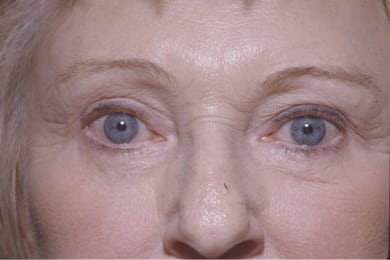 After Image: Eyelid Surgery - front