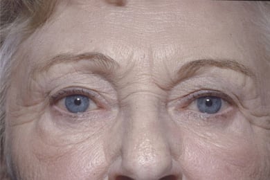 Before Image: Eyelid Surgery - front