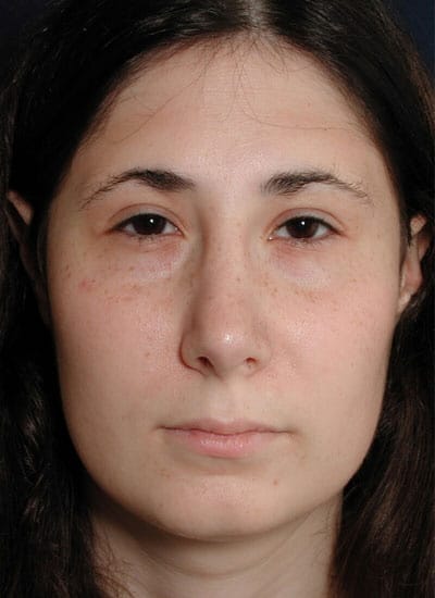 After Image: Eyelid Surgery - front