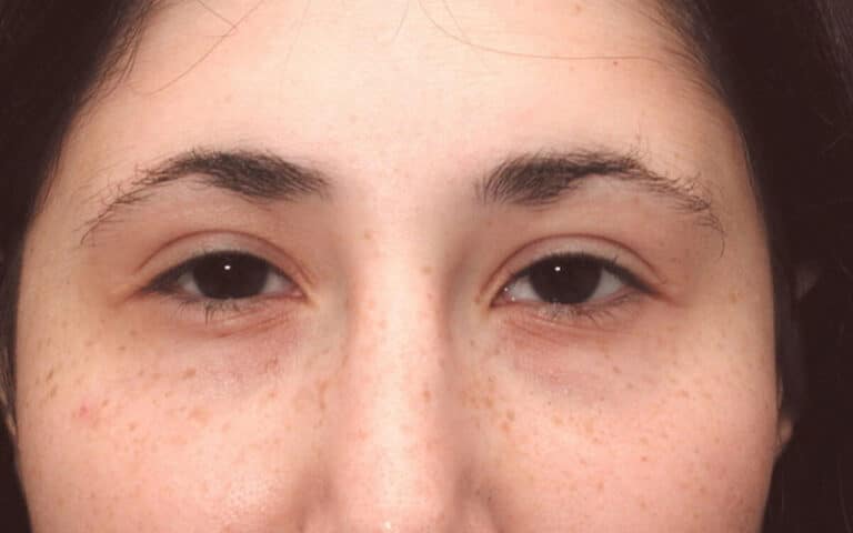 After Image: Eyelid Surgery - front