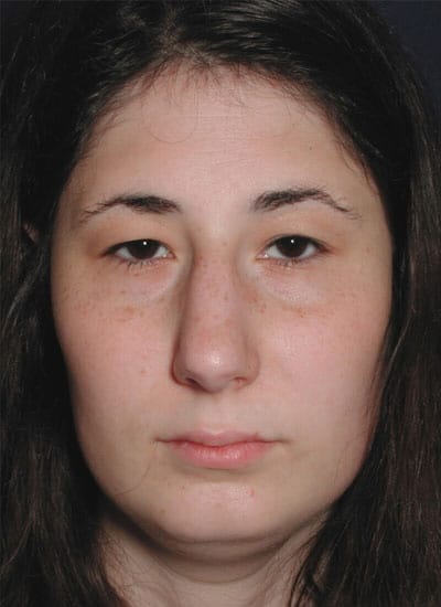 Before Image: Eyelid Surgery - front