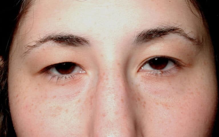 Before Image: Eyelid Surgery - front