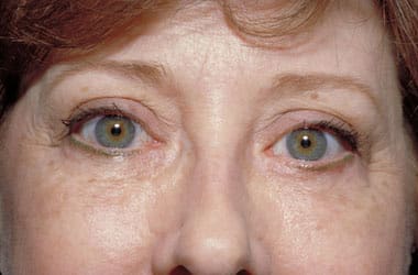 After Image: Eyelid Surgery - front