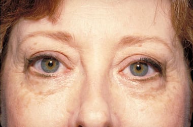 Before Image: Eyelid Surgery - front