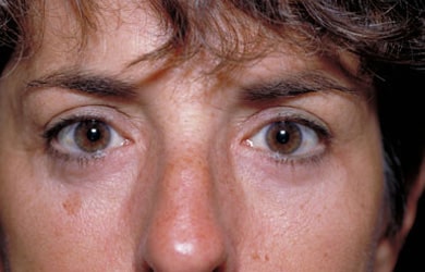 After Image: Eyelid Surgery - front