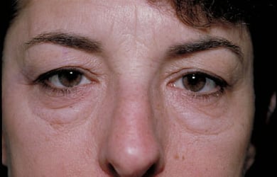 Before Image: Eyelid Surgery - front